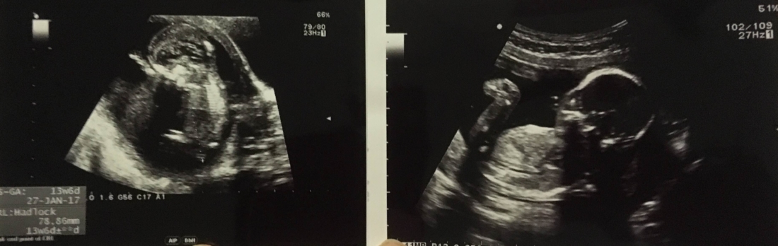 compare-n-contrast-13-and-20-weeks